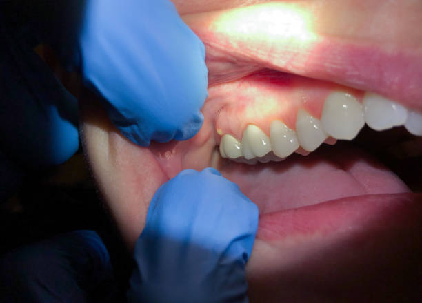 Best Dental Abscess Treatment in Riverbend, WA